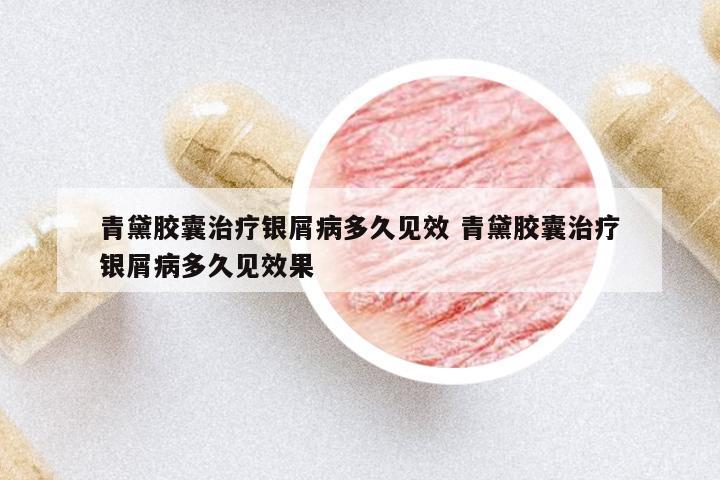 青黛膠囊治療銀屑病多久見效 青黛膠囊治療銀屑病多久見效果