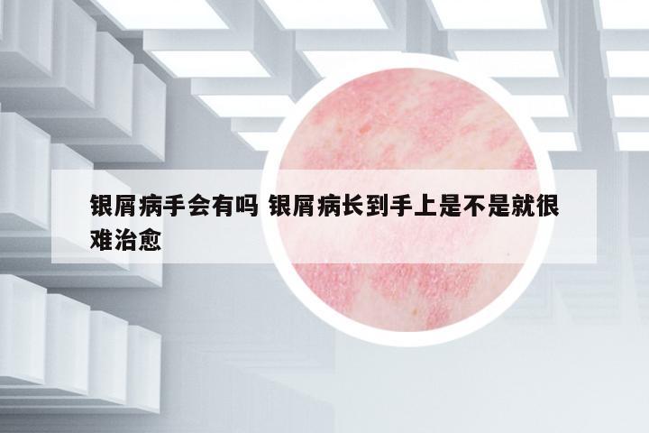 銀屑病手會有嗎 銀屑病長到手上是不是就很難治愈