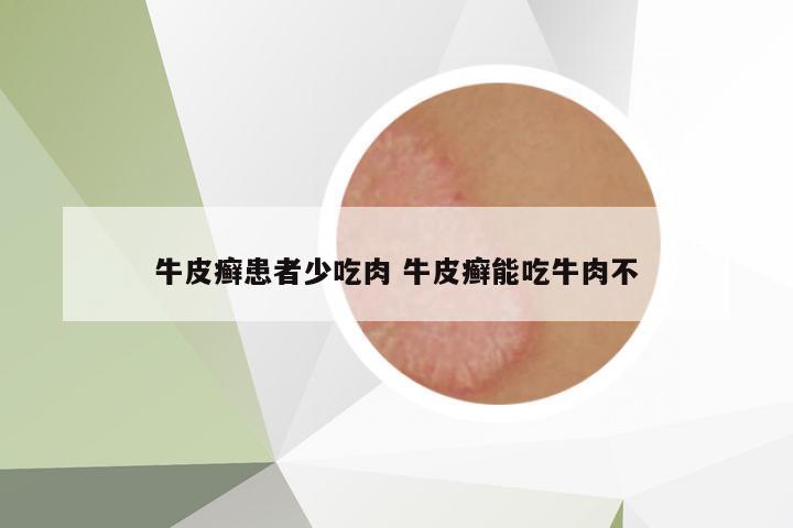 牛皮癬患者少吃肉 牛皮癬能吃牛肉不