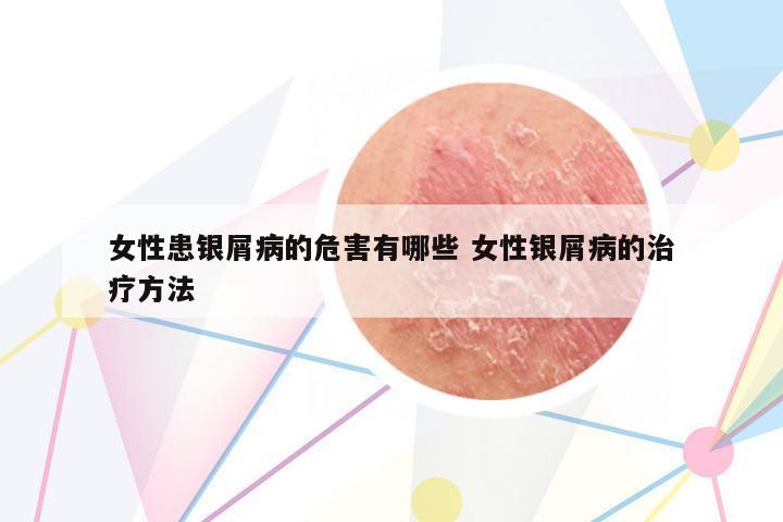 女性患銀屑病的危害有哪些 女性銀屑病的治療方法