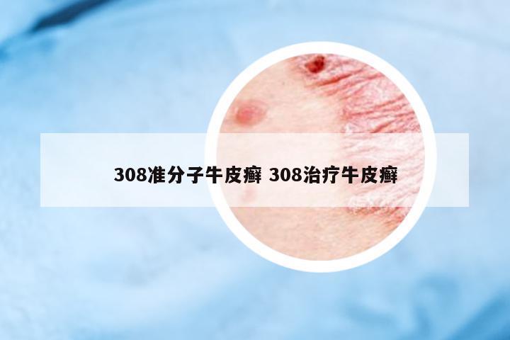 308準分子牛皮癬 308治療牛皮癬