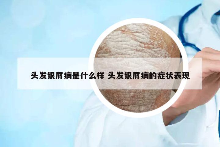 頭發(fā)銀屑病是什么樣 頭發(fā)銀屑病的癥狀表現(xiàn)