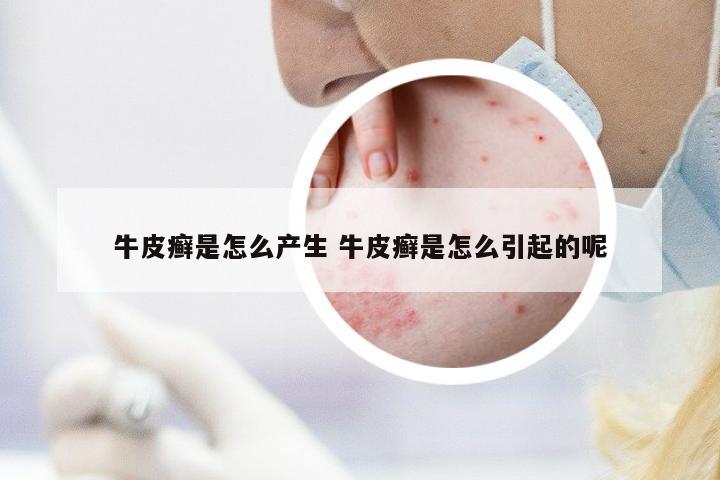 牛皮癬是怎么產(chǎn)生 牛皮癬是怎么引起的呢