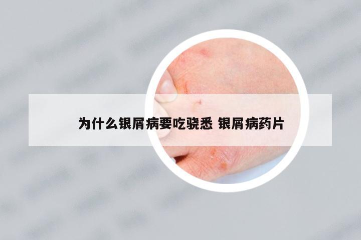 為什么銀屑病要吃驍悉 銀屑病藥片