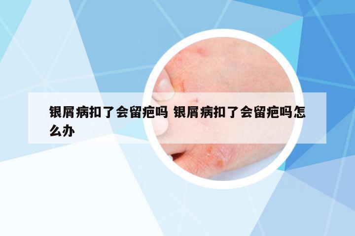 銀屑病扣了會(huì)留疤嗎 銀屑病扣了會(huì)留疤嗎怎么辦