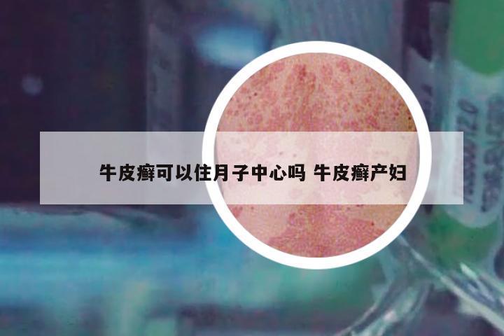 牛皮癬可以住月子中心嗎 牛皮癬產婦