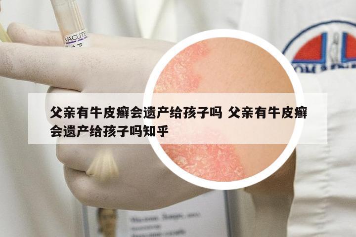 父親有牛皮癬會(huì)遺產(chǎn)給孩子嗎 父親有牛皮癬會(huì)遺產(chǎn)給孩子嗎知乎