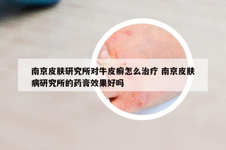 南京皮膚研究所對牛皮癬怎么治療 南京皮膚病研究所的藥膏效果好嗎