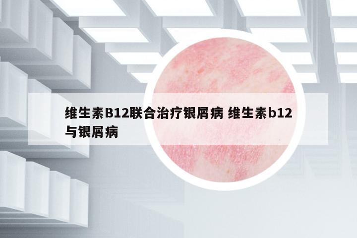 維生素B12聯(lián)合治療銀屑病 維生素b12與銀屑病