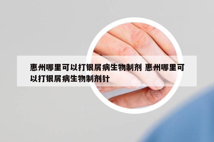 惠州哪里可以打銀屑病生物制劑 惠州哪里可以打銀屑病生物制劑針