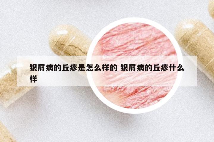 銀屑病的丘疹是怎么樣的 銀屑病的丘疹什么樣