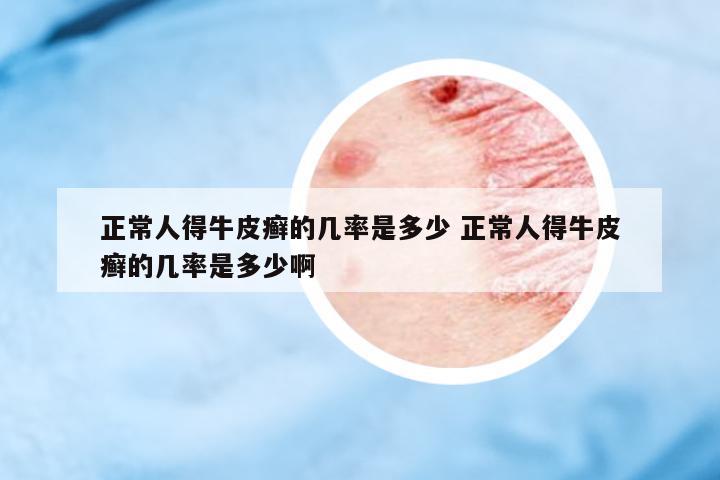 正常人得牛皮癬的幾率是多少 正常人得牛皮癬的幾率是多少啊