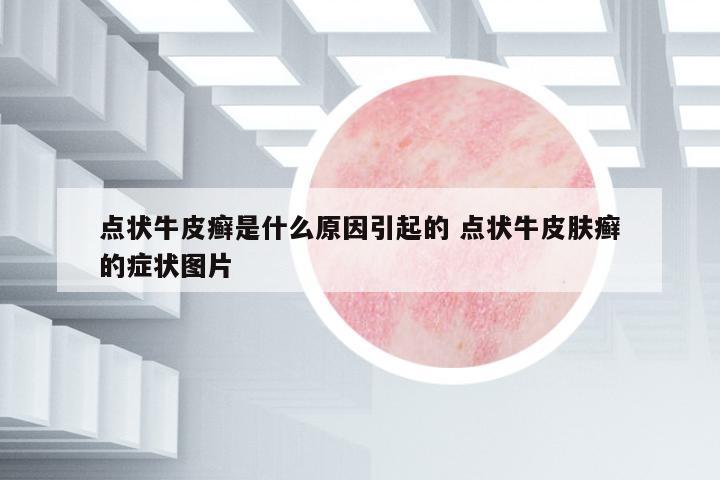 點(diǎn)狀牛皮癬是什么原因引起的 點(diǎn)狀牛皮膚癬的癥狀圖片