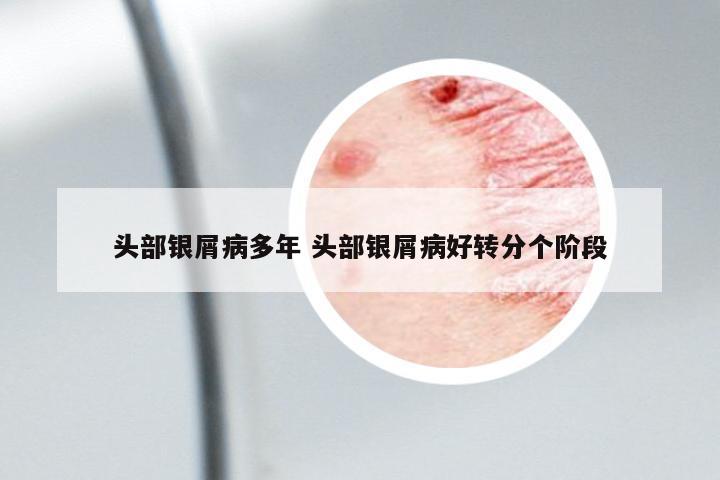 頭部銀屑病多年 頭部銀屑病好轉(zhuǎn)分個階段