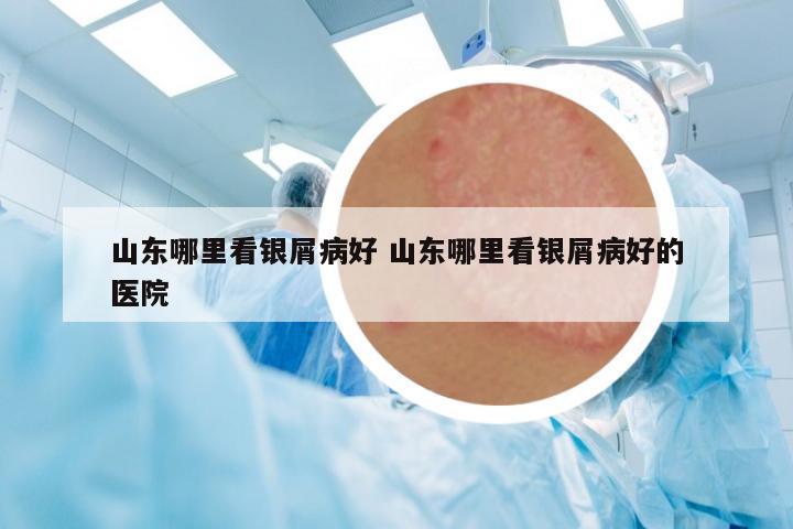 山東哪里看銀屑病好 山東哪里看銀屑病好的醫(yī)院