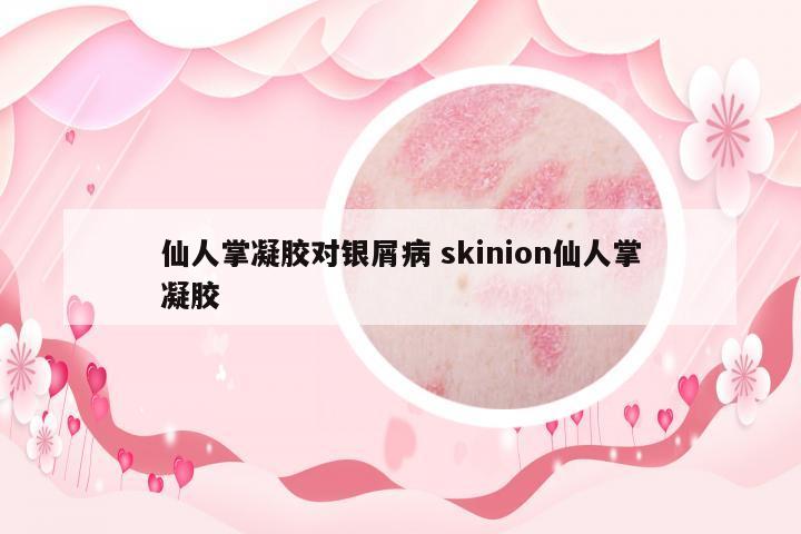 仙人掌凝膠對(duì)銀屑病 skinion仙人掌凝膠