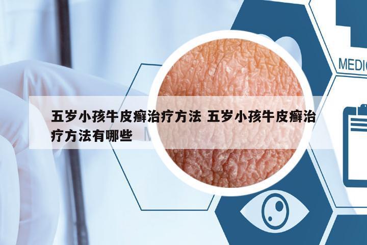 五歲小孩牛皮癬治療方法 五歲小孩牛皮癬治療方法有哪些