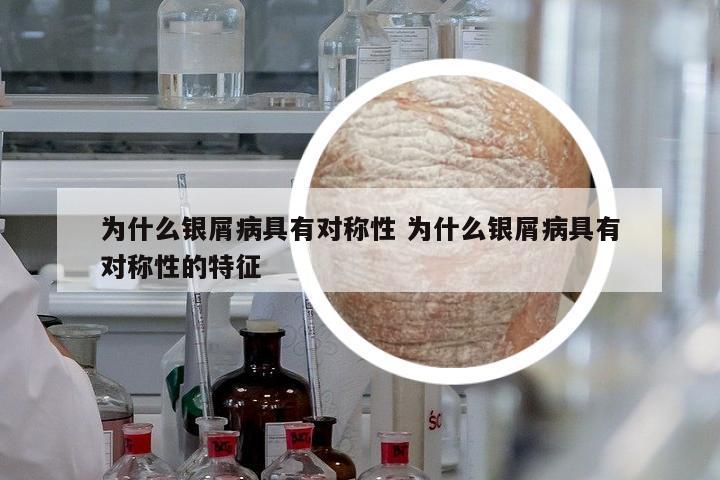 為什么銀屑病具有對稱性 為什么銀屑病具有對稱性的特征