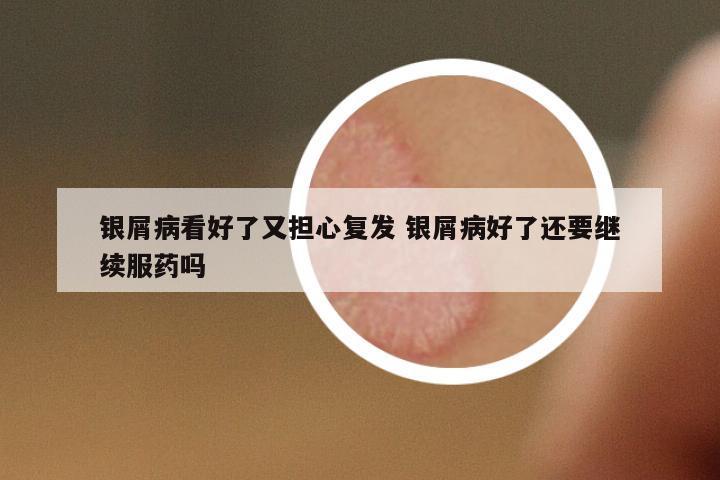 銀屑病看好了又擔(dān)心復(fù)發(fā) 銀屑病好了還要繼續(xù)服藥嗎