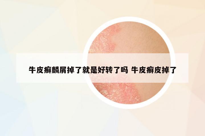 牛皮癬麟屑掉了就是好轉了嗎 牛皮癬皮掉了
