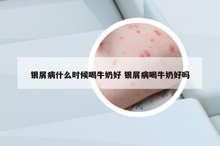 銀屑病什么時(shí)候喝牛奶好 銀屑病喝牛奶好嗎