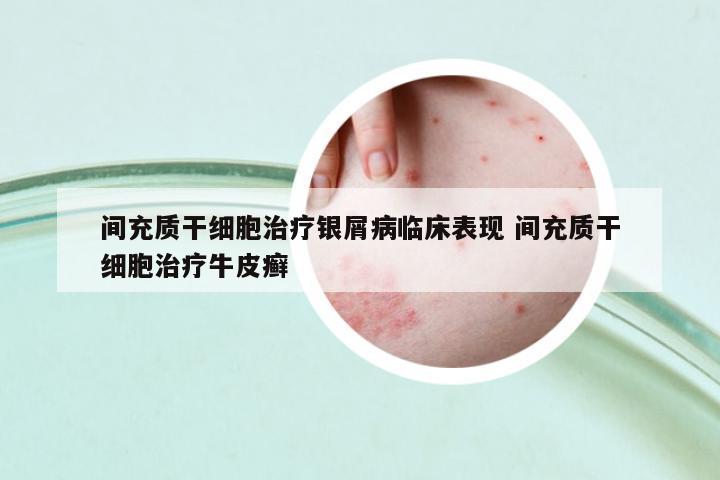 間充質(zhì)干細胞治療銀屑病臨床表現(xiàn) 間充質(zhì)干細胞治療牛皮癬