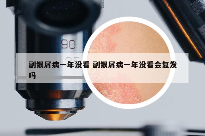 副銀屑病一年沒(méi)看 副銀屑病一年沒(méi)看會(huì)復(fù)發(fā)嗎