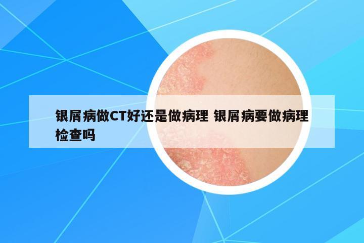 銀屑病做CT好還是做病理 銀屑病要做病理檢查嗎