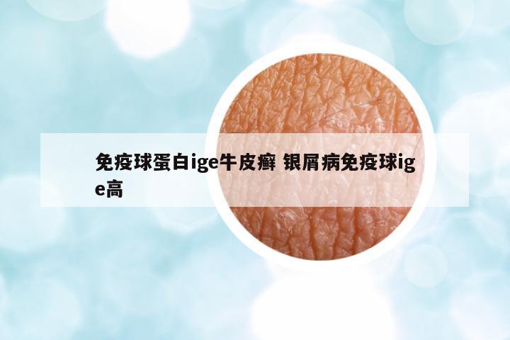 免疫球蛋白ige牛皮癬 銀屑病免疫球ige高