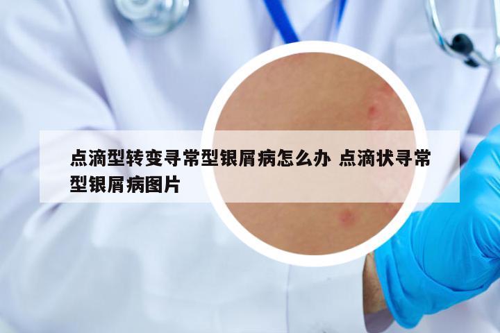 點滴型轉(zhuǎn)變尋常型銀屑病怎么辦 點滴狀尋常型銀屑病圖片