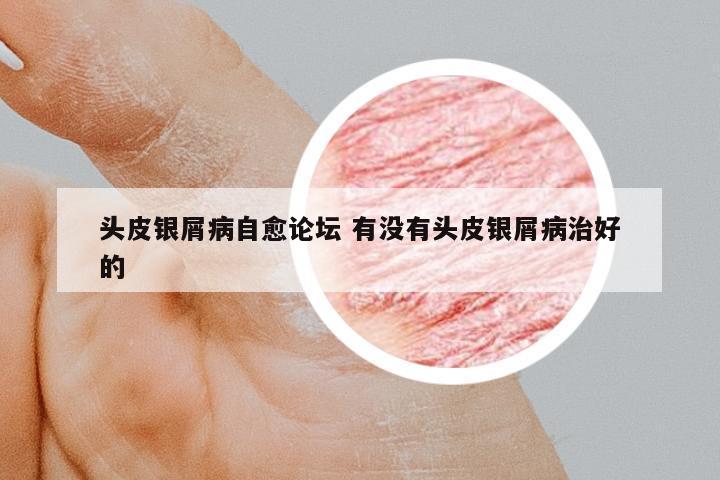 頭皮銀屑病自愈論壇 有沒(méi)有頭皮銀屑病治好的