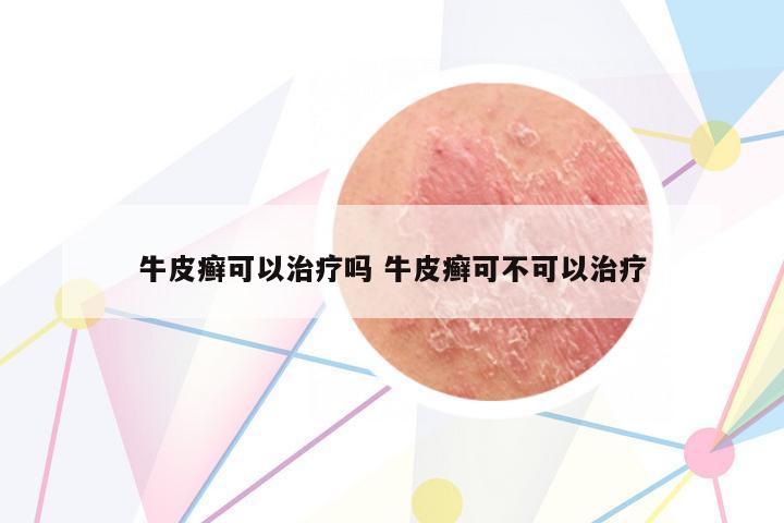 牛皮癬可以治療嗎 牛皮癬可不可以治療