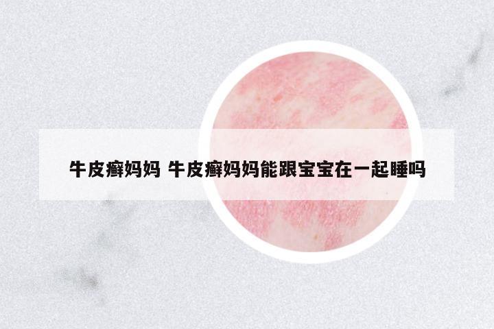 牛皮癬媽媽 牛皮癬媽媽能跟寶寶在一起睡嗎