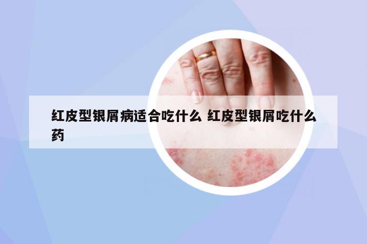 紅皮型銀屑病適合吃什么 紅皮型銀屑吃什么藥