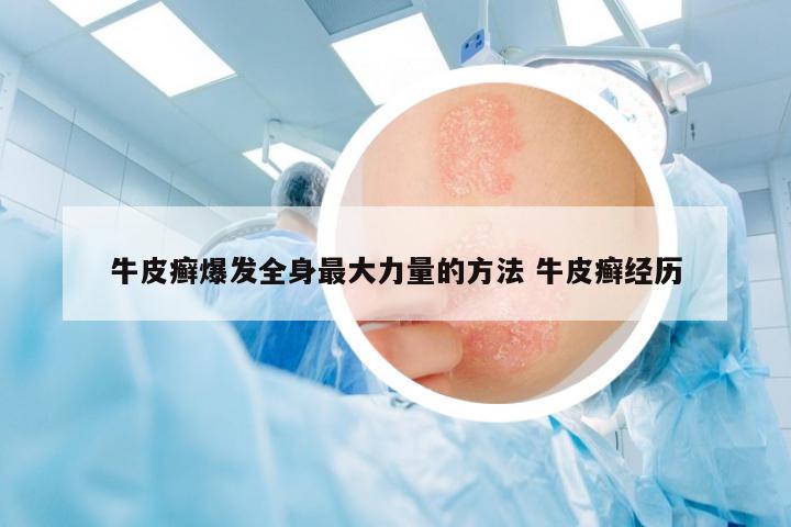 牛皮癬爆發(fā)全身最大力量的方法 牛皮癬經(jīng)歷