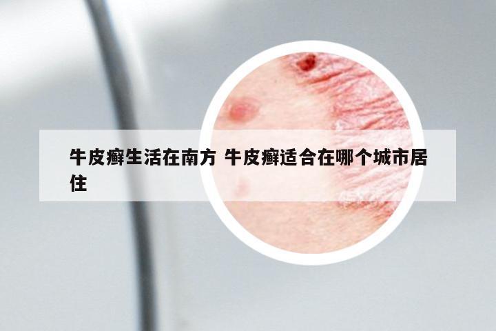 牛皮癬生活在南方 牛皮癬適合在哪個(gè)城市居住