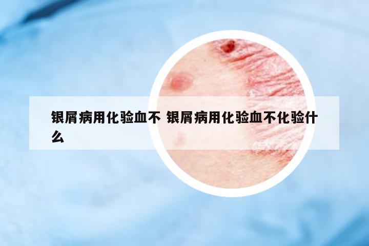 銀屑病用化驗血不 銀屑病用化驗血不化驗什么