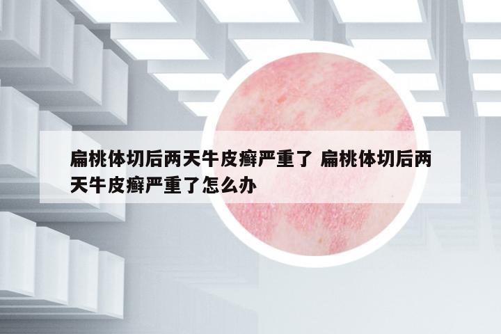 扁桃體切后兩天牛皮癬嚴重了 扁桃體切后兩天牛皮癬嚴重了怎么辦