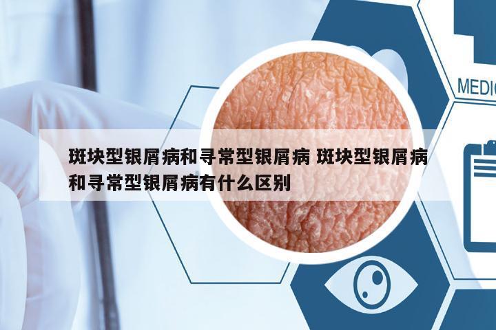 斑塊型銀屑病和尋常型銀屑病 斑塊型銀屑病和尋常型銀屑病有什么區(qū)別