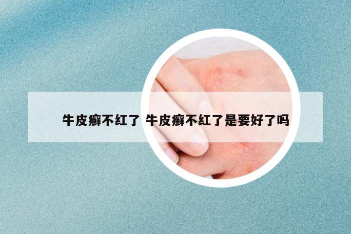 牛皮癬不紅了 牛皮癬不紅了是要好了嗎