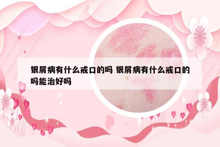 銀屑病有什么戒口的嗎 銀屑病有什么戒口的嗎能治好嗎