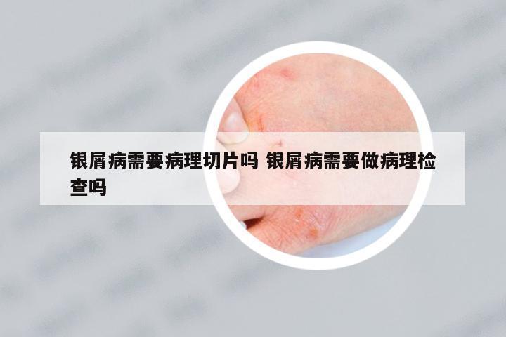 銀屑病需要病理切片嗎 銀屑病需要做病理檢查嗎