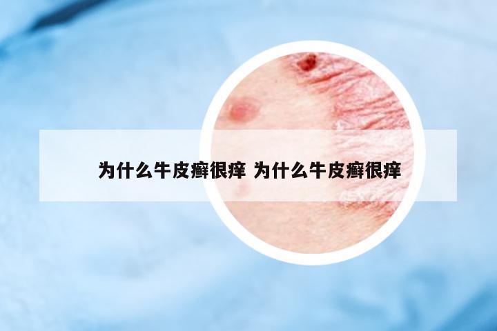 為什么牛皮癬很癢 為什么牛皮癬很癢