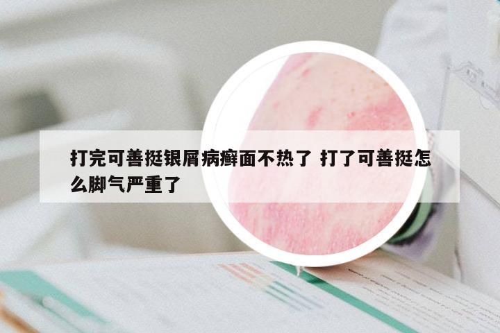 打完可善挺銀屑病癬面不熱了 打了可善挺怎么腳氣嚴(yán)重了