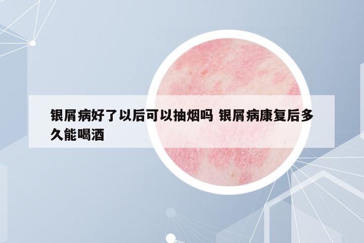 銀屑病好了以后可以抽煙嗎 銀屑病康復(fù)后多久能喝酒