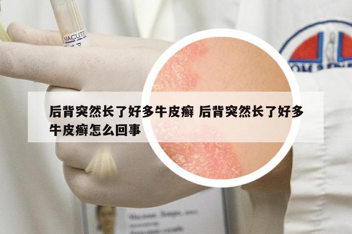 后背突然長了好多牛皮癬 后背突然長了好多牛皮癬怎么回事