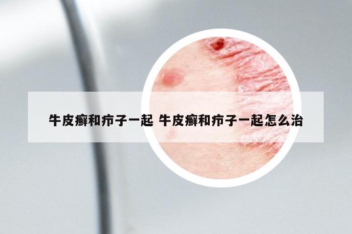 牛皮癬和癤子一起 牛皮癬和癤子一起怎么治