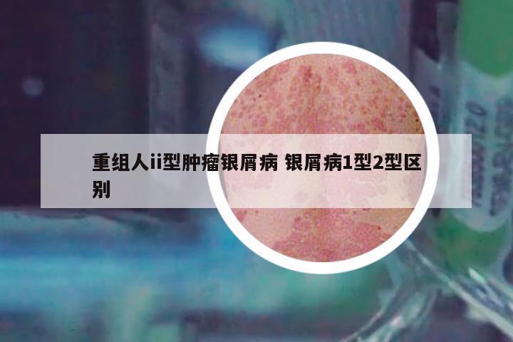 重組人ii型腫瘤銀屑病 銀屑病1型2型區(qū)別