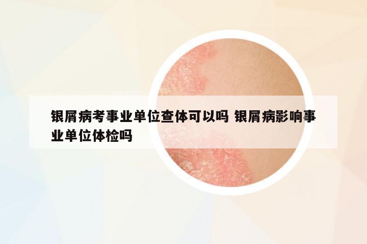 銀屑病考事業(yè)單位查體可以嗎 銀屑病影響事業(yè)單位體檢嗎