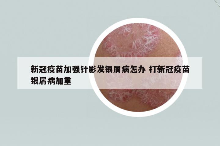 新冠疫苗加強針影發(fā)銀屑病怎辦 打新冠疫苗銀屑病加重